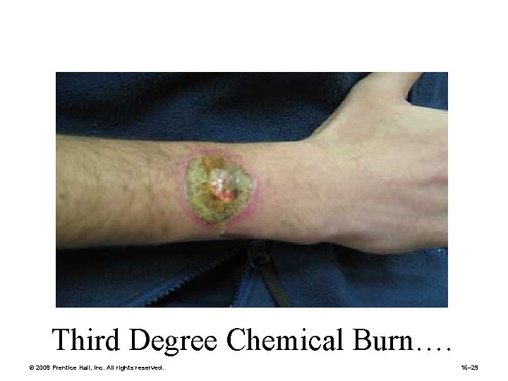 Third Degree Chemical Burn…. © 2008 Prentice Hall, Inc. All rights reserved. 16– 29
