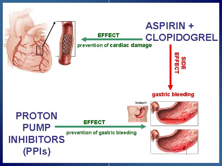 EFFECT ASPIRIN + CLOPIDOGREL prevention of cardiac damage SIDE EFFECT gastric bleeding PROTON EFFECT