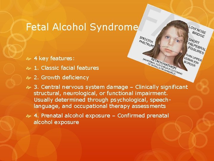 Fetal Alcohol Syndrome 4 key features: 1. Classic facial features 2. Growth deficiency 3. Fetal Alcohol Syndrome 4 key features: 1. Classic facial features 2. Growth deficiency 3.