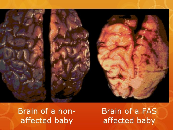 Brain of a nonaffected baby Brain of a FAS affected baby Brain of a nonaffected baby Brain of a FAS affected baby
