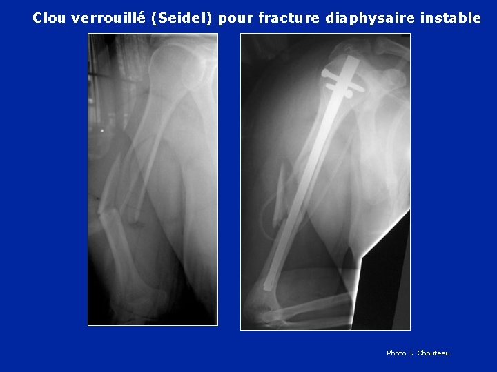 Clou verrouillé (Seidel) pour fracture diaphysaire instable Photo J. Chouteau 