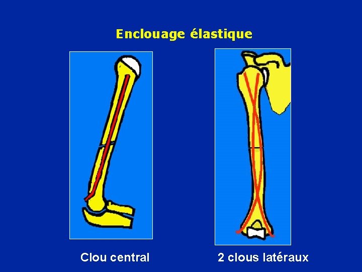 Enclouage élastique Clou central 2 clous latéraux 