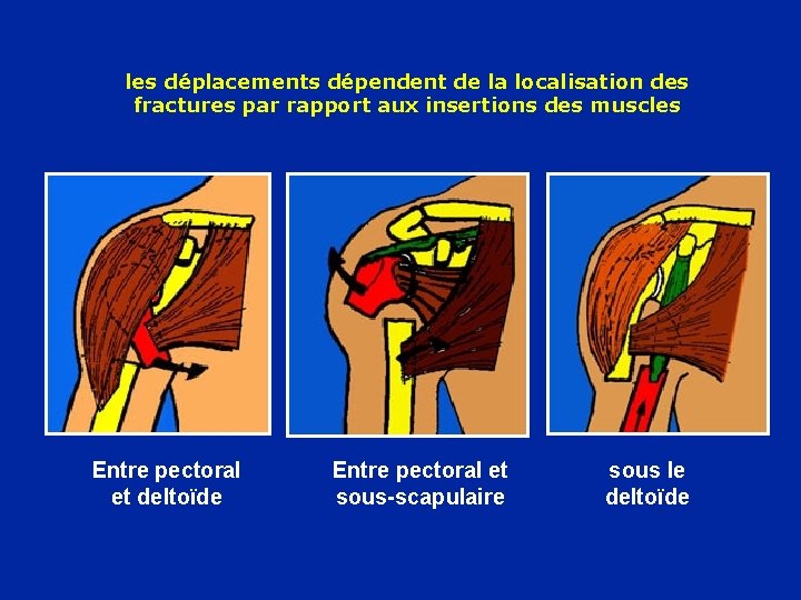 les déplacements dépendent de la localisation des fractures par rapport aux insertions des muscles