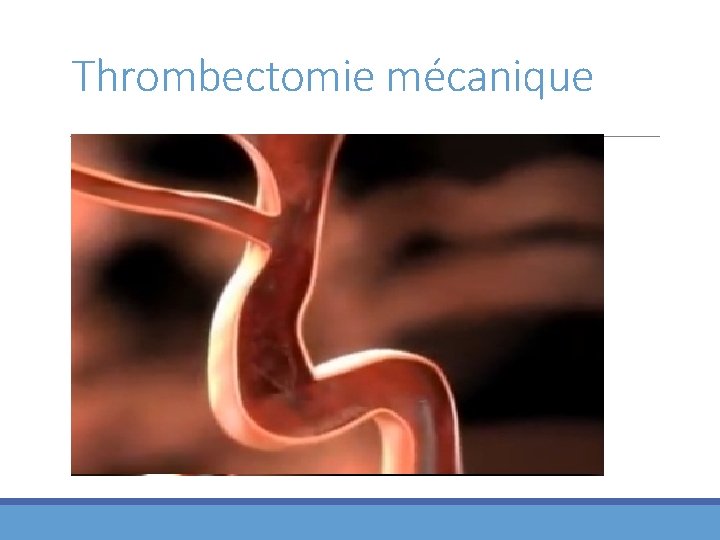 Thrombectomie mécanique 