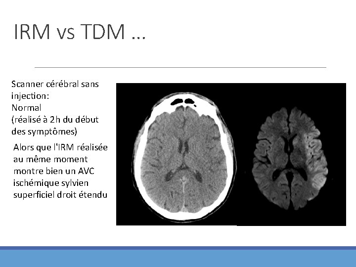 IRM vs TDM … Scanner cérébral sans injection: Normal (réalisé à 2 h du
