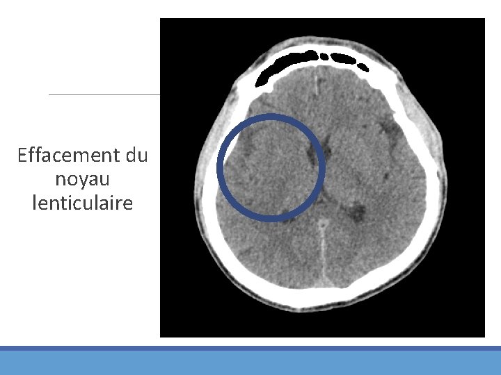 Effacement du noyau lenticulaire 