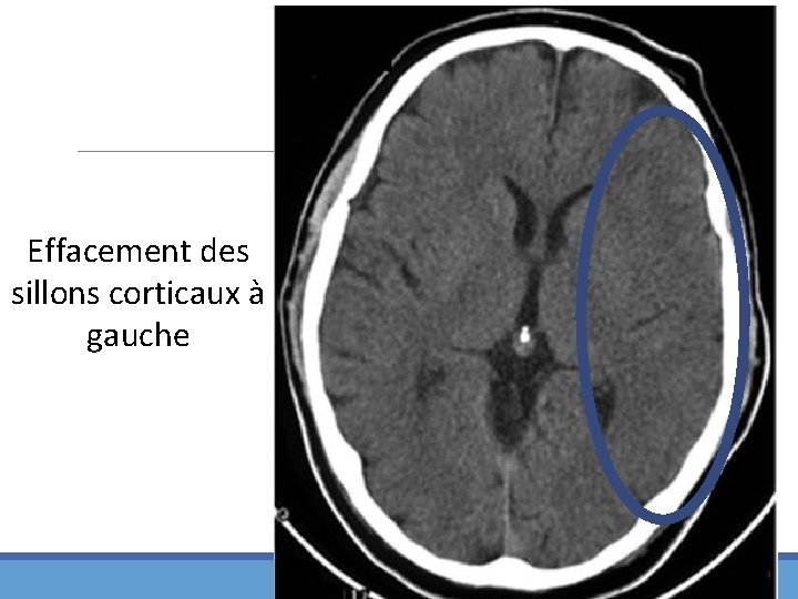 Effacement des sillons corticaux à gauche 