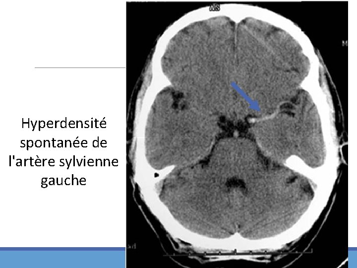 Hyperdensité spontanée de l'artère sylvienne gauche 