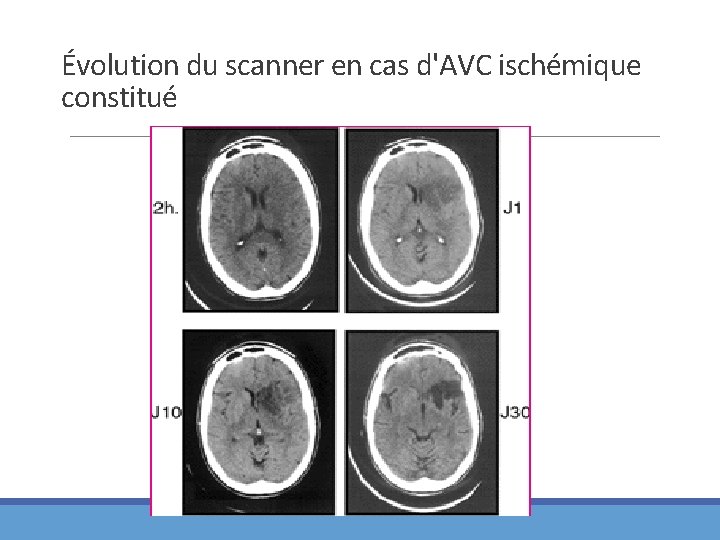 Évolution du scanner en cas d'AVC ischémique constitué 