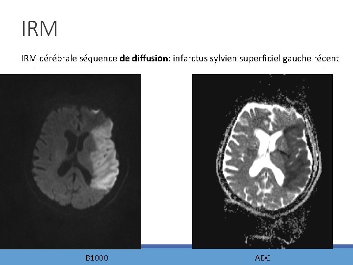 IRM cérébrale séquence de diffusion: infarctus sylvien superficiel gauche récent B 1000 ADC 