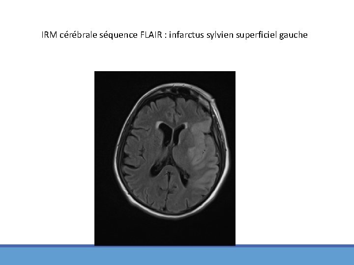 IRM cérébrale séquence FLAIR : infarctus sylvien superficiel gauche 