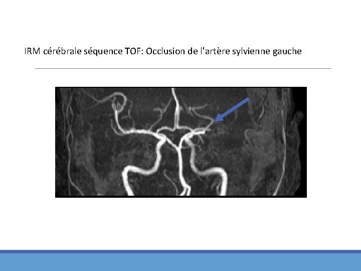 IRM cérébrale séquence TOF: Occlusion de l'artère sylvienne gauche 
