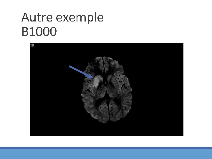 Autre exemple B 1000 