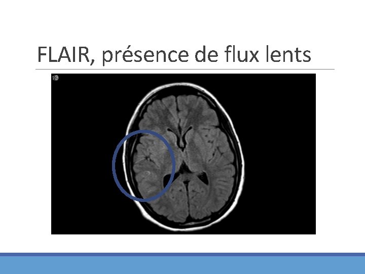 FLAIR, présence de flux lents 