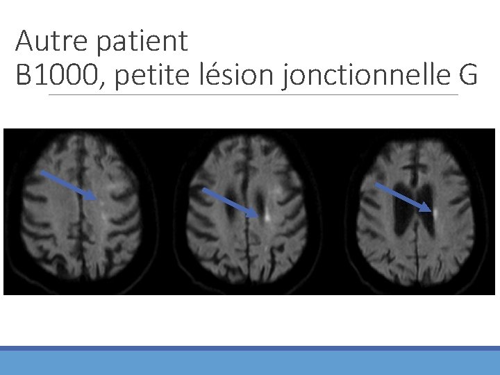 Autre patient B 1000, petite lésion jonctionnelle G 