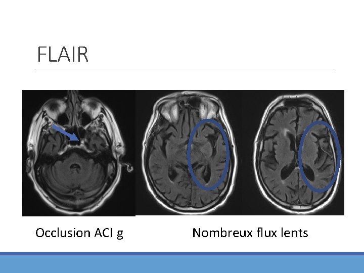 FLAIR Occlusion ACI g Nombreux flux lents 