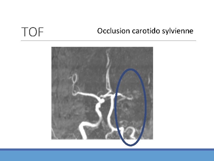 TOF Occlusion carotido sylvienne 