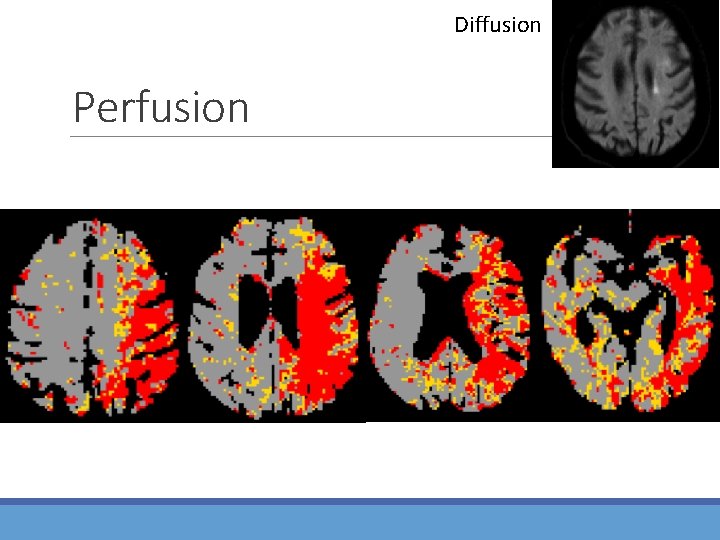 Diffusion Perfusion 