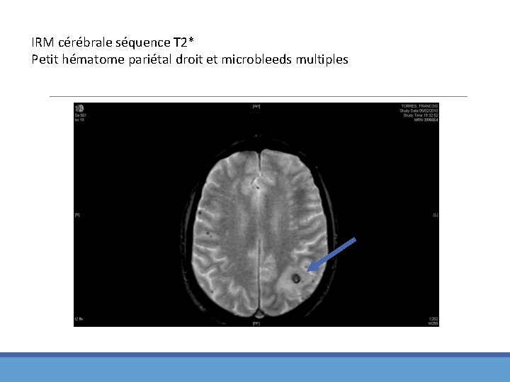 IRM cérébrale séquence T 2* Petit hématome pariétal droit et microbleeds multiples 