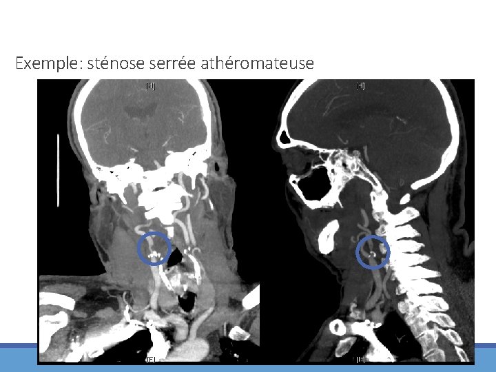 Exemple: sténose serrée athéromateuse 