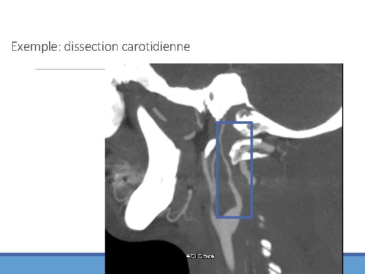Exemple: dissection carotidienne 