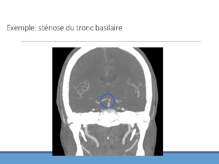 Exemple: sténose du tronc basilaire 