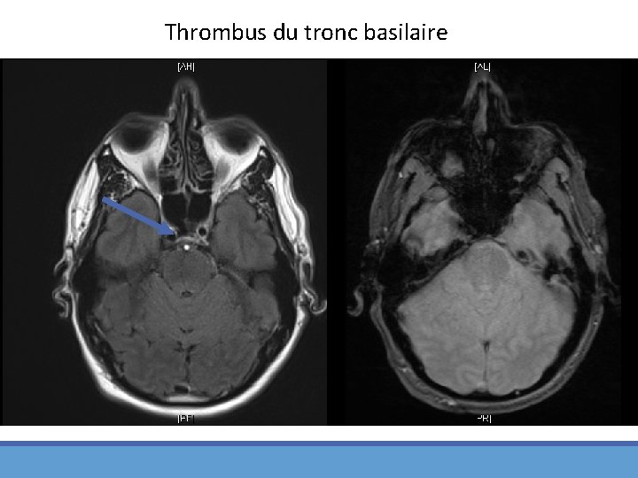 Thrombus du tronc basilaire 