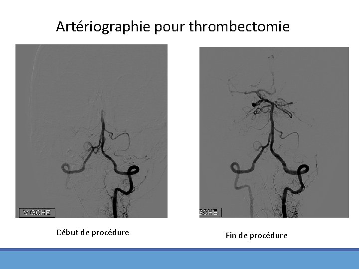 Artériographie pour thrombectomie Début de procédure Fin de procédure 