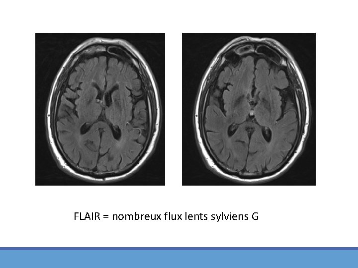 FLAIR = nombreux flux lents sylviens G 