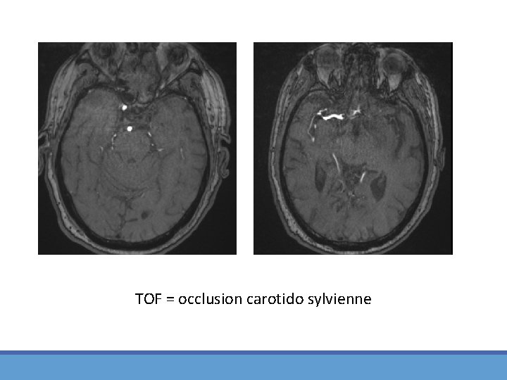 TOF = occlusion carotido sylvienne 