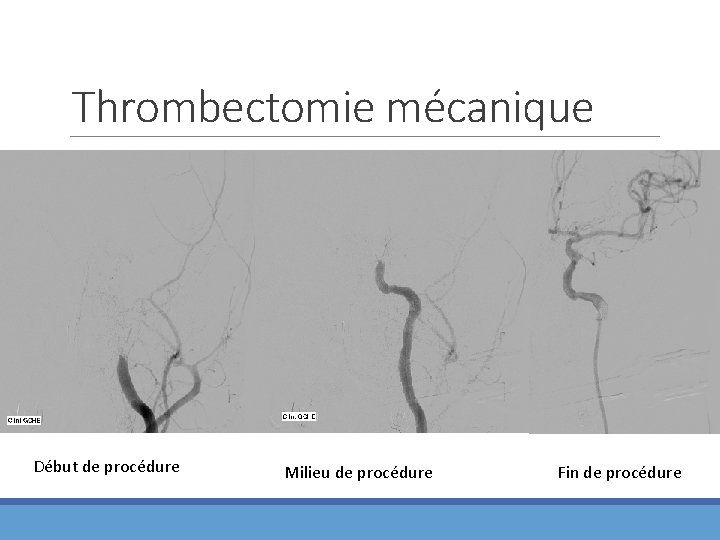 Thrombectomie mécanique Début de procédure Milieu de procédure Fin de procédure 