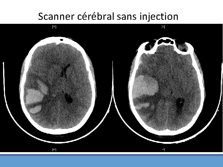 Scanner cérébral sans injection 