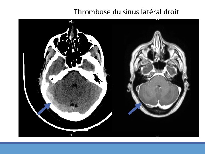 Thrombose du sinus latéral droit 