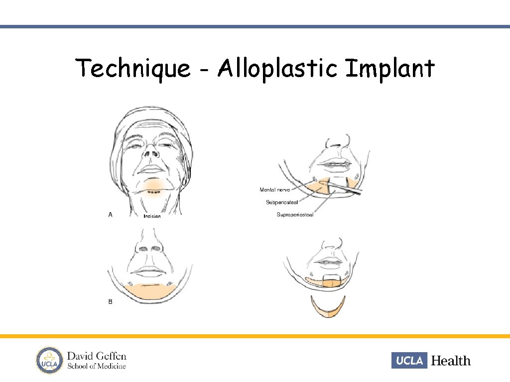 Technique - Alloplastic Implant 