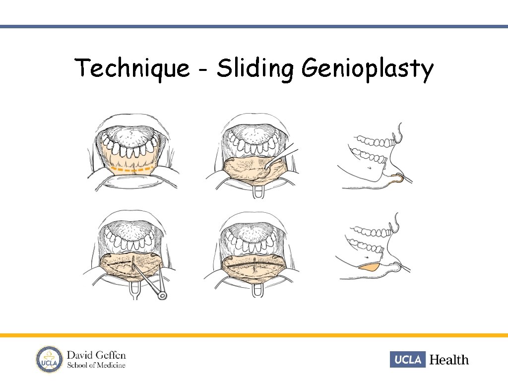 Technique - Sliding Genioplasty 