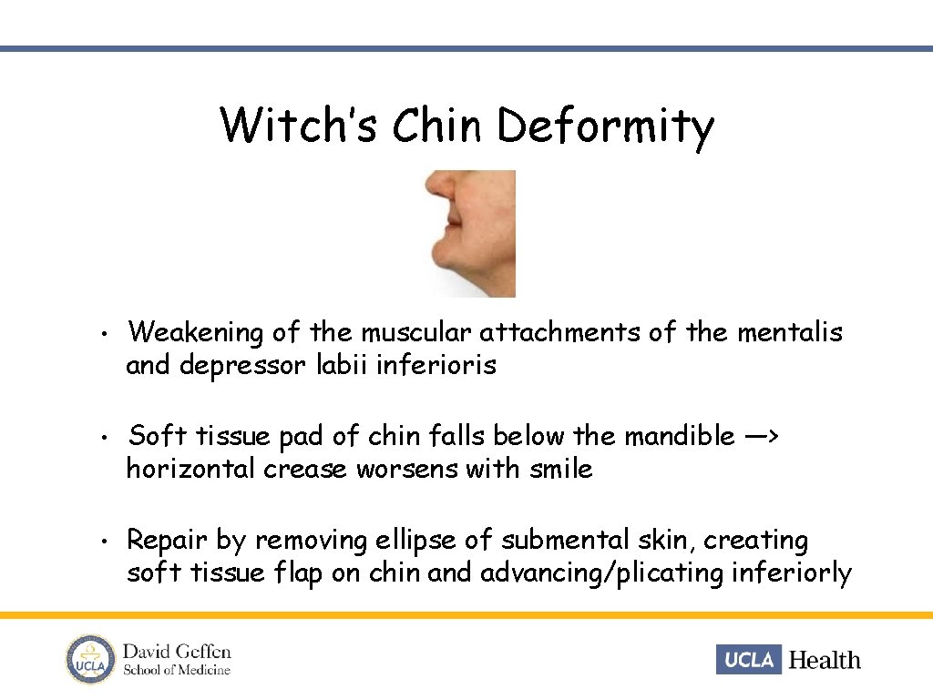 Witch’s Chin Deformity • Weakening of the muscular attachments of the mentalis and depressor