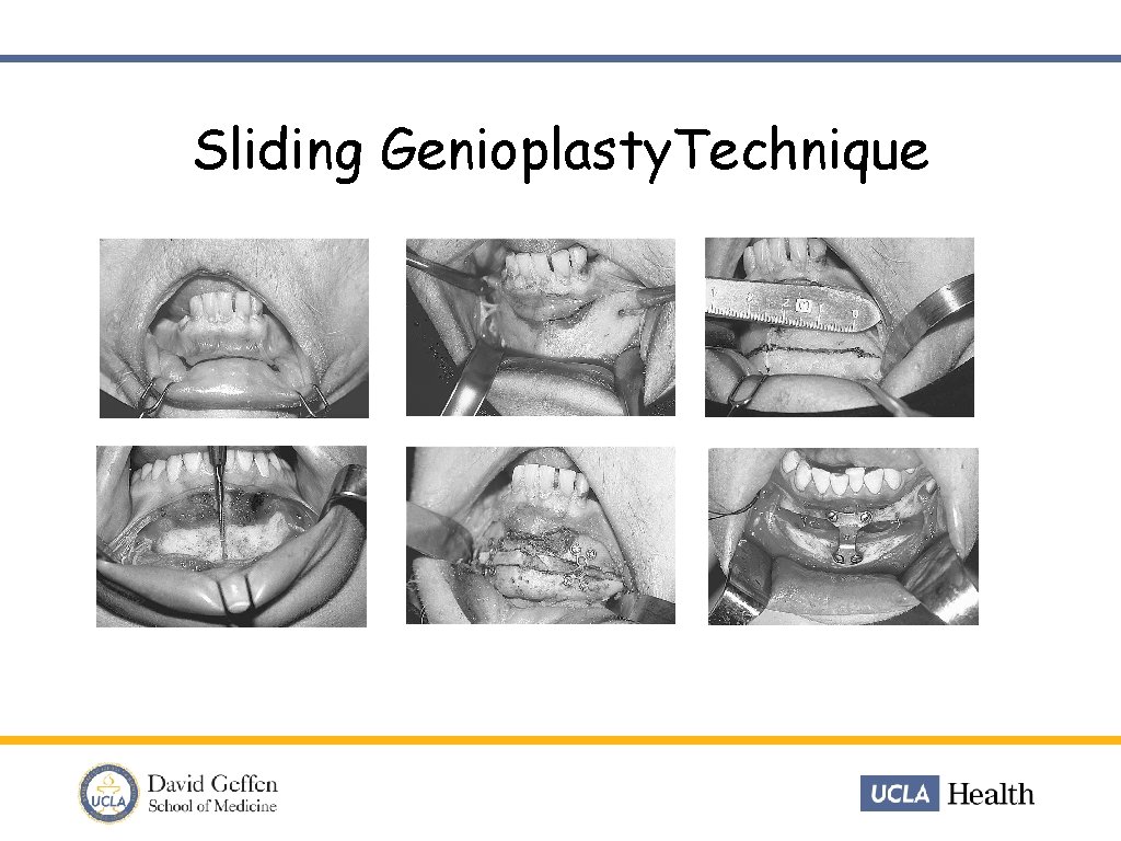 Sliding Genioplasty. Technique 