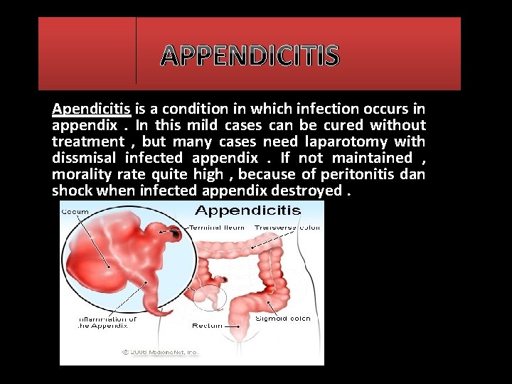 APPENDICITIS Apendicitis is a condition in which infection occurs in appendix. In this mild