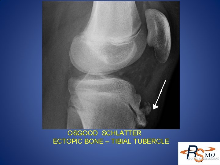 OSGOOD SCHLATTER ECTOPIC BONE – TIBIAL TUBERCLE 
