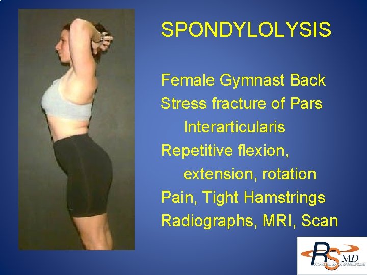 SPONDYLOLYSIS Female Gymnast Back Stress fracture of Pars Interarticularis Repetitive flexion, extension, rotation Pain,