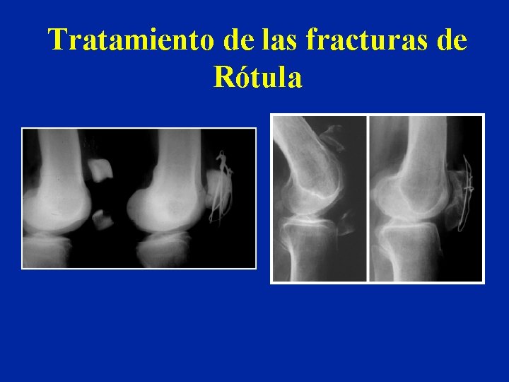 Tratamiento de las fracturas de Rótula Tratamiento de las fracturas de Rótula