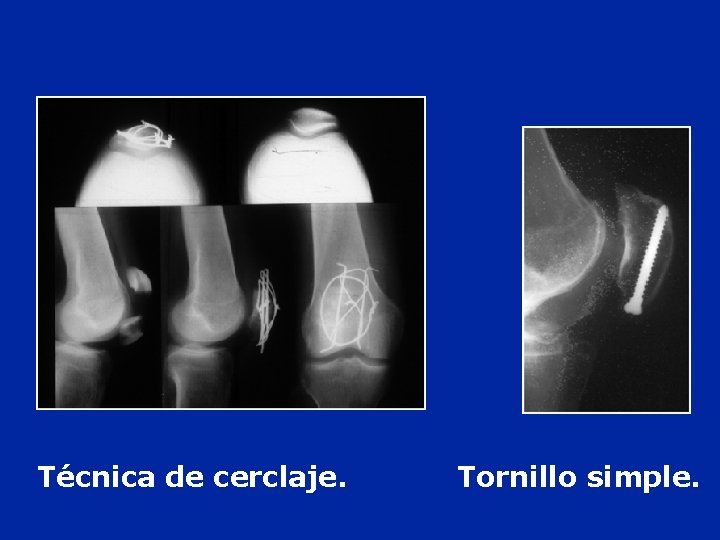 Técnica de cerclaje. Tornillo simple. Técnica de cerclaje. Tornillo simple.