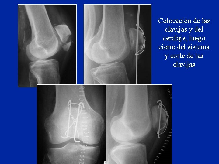 Colocación de las clavijas y del cerclaje, luego cierre del sistema y corte de Colocación de las clavijas y del cerclaje, luego cierre del sistema y corte de