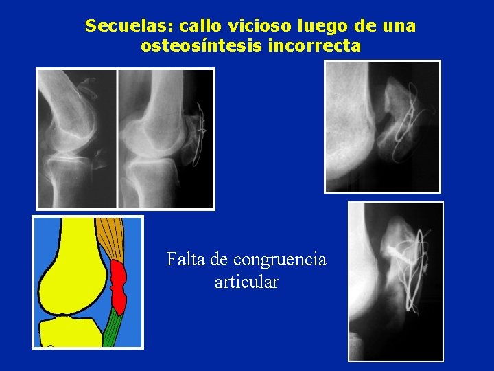 Secuelas: callo vicioso luego de una osteosíntesis incorrecta Falta de congruencia articular Secuelas: callo vicioso luego de una osteosíntesis incorrecta Falta de congruencia articular
