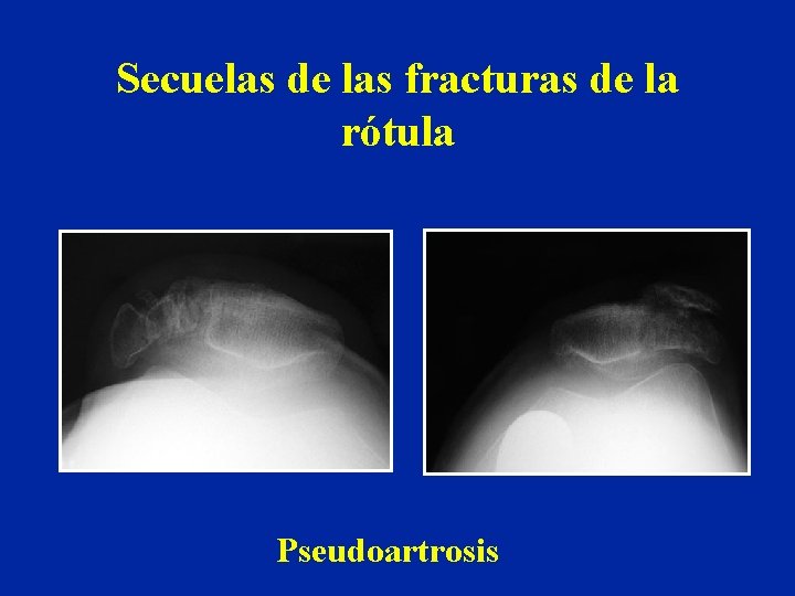 Secuelas de las fracturas de la rótula Pseudoartrosis Secuelas de las fracturas de la rótula Pseudoartrosis