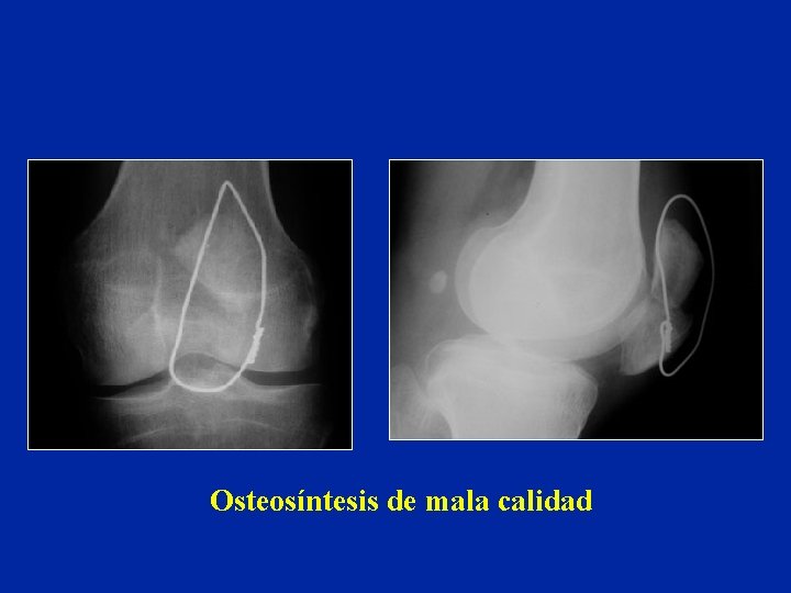 Osteosíntesis de mala calidad Osteosíntesis de mala calidad