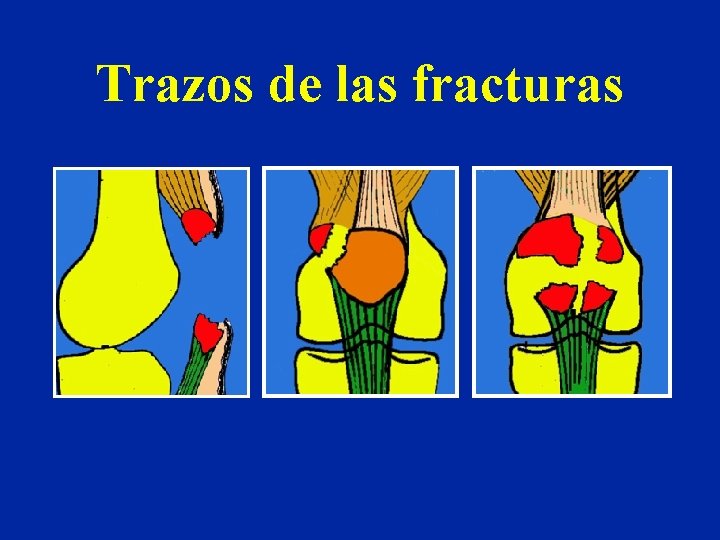 Trazos de las fracturas Trazos de las fracturas