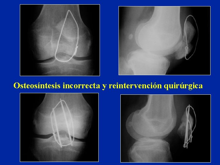 Osteosíntesis incorrecta y reintervención quirúrgica Osteosíntesis incorrecta y reintervención quirúrgica
