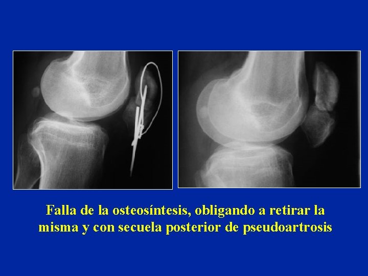 Falla de la osteosíntesis, obligando a retirar la misma y con secuela posterior de Falla de la osteosíntesis, obligando a retirar la misma y con secuela posterior de