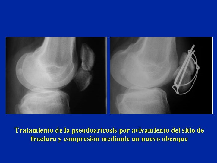 Tratamiento de la pseudoartrosis por avivamiento del sitio de fractura y compresión mediante un Tratamiento de la pseudoartrosis por avivamiento del sitio de fractura y compresión mediante un